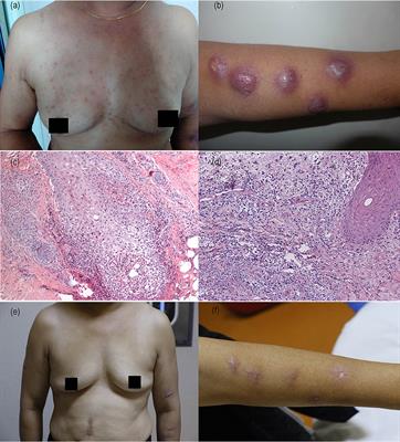 Thalidomide in the Treatment of Sweet's Syndrome and Eosinophilic Folliculitis Associated With Immune Reconstitution Inflammatory Syndrome